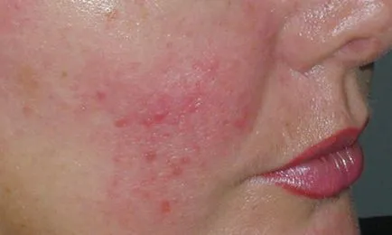 Hogyan kell kezelni a rosacea az arcán