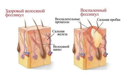 Как да се отървете от акне кистозна, здравни тайни