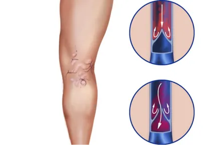 Как за лечение на разширени вени на краката при жените и мъжете свидетелства и функции, uflebologa