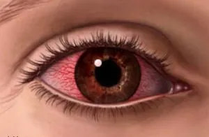 Cum de a elimina roseata din jurul ochilor - sfaturi oftalmolog