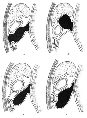 Chisturile pancreasului