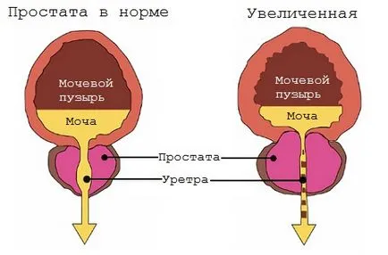 Китайски урологични кръпка на разширения на простатата при мъжете