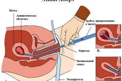 Fibrom uterin cauze, simptome și tratament