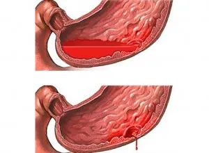 simptome gastro-erozive, tratamentul