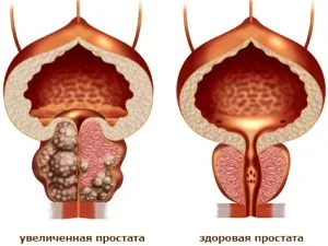 prostatita fibrotic