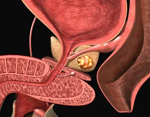 Fibroza din cauze de prostata, simptome, tratament