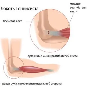 Epicondylitis a könyök ízületi tünetek és a kezelés típusa, diagnosztika