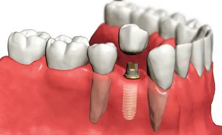 Crown, bridge sau implant, care este cel mai bine și cum de a alege