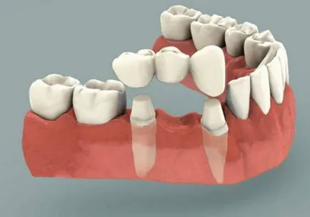 Crown, bridge sau implant, care este cel mai bine și cum de a alege