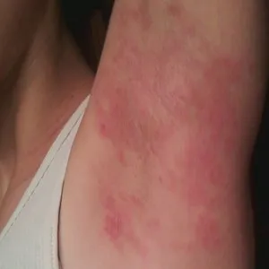 Tratamentul și simptome de alergie la deodorant - Totul despre alergii
