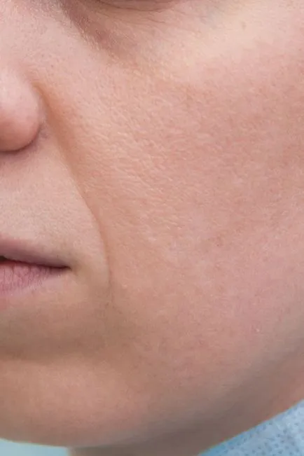 Tratamentul post-acnee cu ajutorul laserului Fraxel re magazin