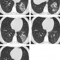 Diagnosticul radiologic de pneumonie - bisturiu - informații medicale și portal educațional