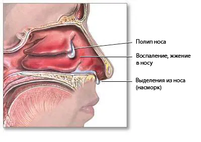 Ние се отнасяме към носни полипи