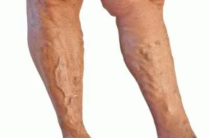 Масаж крака с разширени възможно видове лечебни