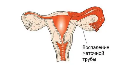 Фалопиевите тръби видове заболявания и методи за лечение