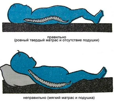 Matrac gerincferdülés, hogy melyiket válassza, hogyan kell aludni scoliosis
