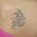 A kémiai eljárás tetoválás eltávolítás, tetoválás