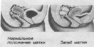 Folk si medicina populara alternativa remedii pentru uterină Bend