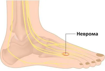 Neuroma simptomele și tratamentul piciorului la domiciliu, terapia conservatoare a lui Morton