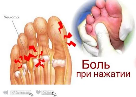 Morton Neuroma