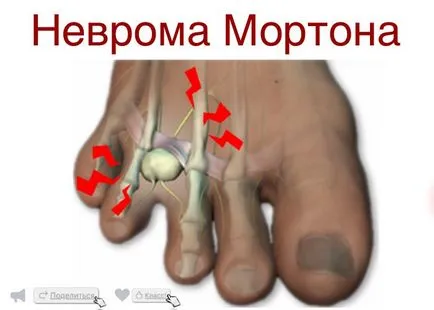 Morton Neuroma