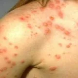 Simptomele variolei de tratament, prevenire - bisturiu - informații medicale și portal educațional