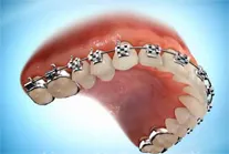Усложнения след инсталирането на скоби, статии, разбираемо стоматология за пациентите онлайн диагностик,