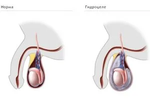 Orhiectomie cursul operațiunii și perioada de recuperare