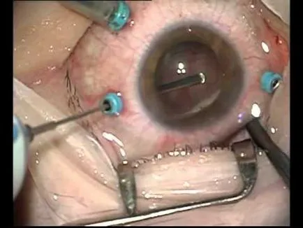 Работа при отлепване на ретината в Белгия, основните терапии разслояване