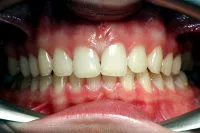 fogfehérítés, fehéríti a fogakat, hogyan fehéríti a fogakat - Fogászati ​​portál Krasznojarszk
