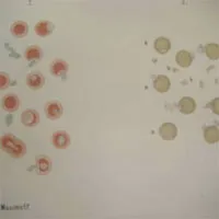 Departamentul de Hematologie, chimioterapie impotriva cancerului de droguri si de transplant de măduvă osoasă