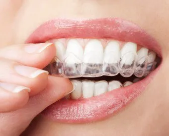 Избелване на зъбите активен въглен предимства, по-специално процедури, рецепти
