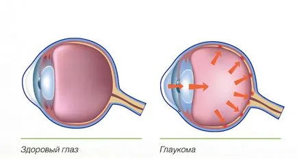 Papilledema симптоми, причини, лечение