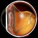 отлепване на ретината (разслояване) - причини, симптомите и лечението