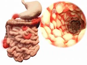 peritonita intestinale prognostic, simptome, cauze