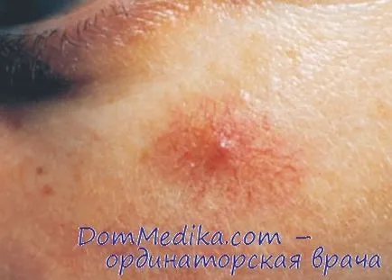 Spider hemangioma - diagnosztika, a kezelés