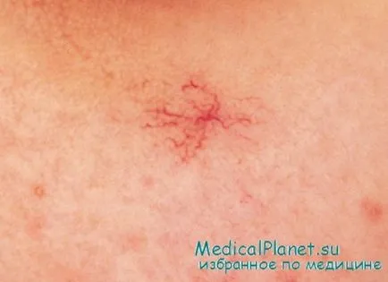 Spider hemangioma - diagnosztika, a kezelés