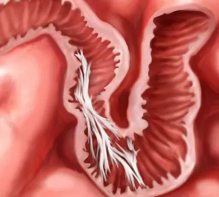 peritonita intestinale prognostic, simptome, cauze