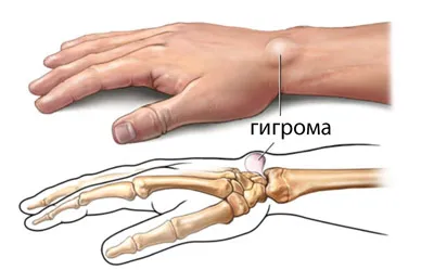 Hygroma китките, дланите, стъпалата - лечение, причини