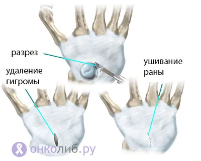 Hygroma китките, дланите, стъпалата - лечение, причини