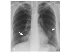 cancer pulmonar Pleurezia la simptome, tratament, prognosticul