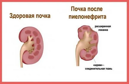 Pyelonephritis, tünetek, kezelés, különösen a betegség a terhes nők és a gyermekek