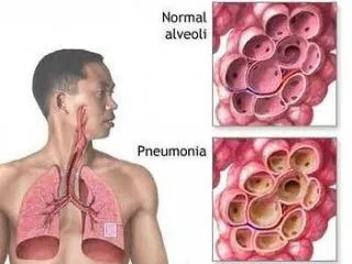 Пневмония - това е опасно!
