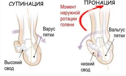 Плосък валгус деформация stopyopisanie общи заболявания и лечението