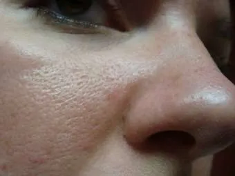 piele poroasa feței - tratament la domiciliu, cum să scape de și ce să facă „toate detaliile“