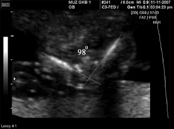 Пренатална диагностика на вродени сърдечни заболявания в ултразвук скенер SonoAce-8000 EX -