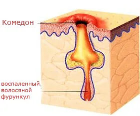 Използването на цинк и мазила, пасти от акне по лицето и тялото, акне, комедони, ревюта със снимки преди и