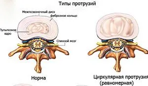 Причини и лечение на кръгово гръбната диск издатина