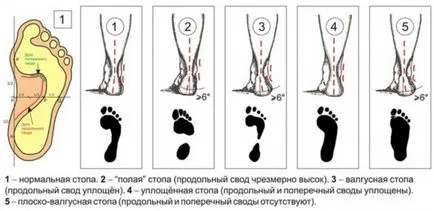 Предотвратяване на плоско стъпало при деца на различна възраст