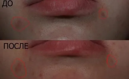 Utilizarea de unguente zinc și paste de la acnee pe față și corp, acnee, comedoame, comentarii cu fotografii înainte și